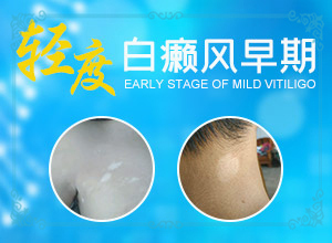 男性生殖器表皮有白殿痒怎么办