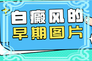 介绍儿童白点癫风治疗时的注意事项