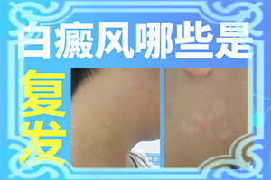 治疗肢端型白点癫风的方法都有什么