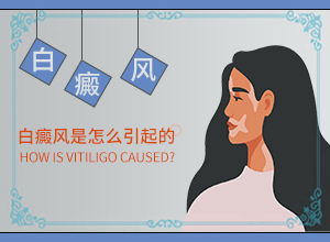 脸上白癞风就擦药膏不用吃药吗怎么治好