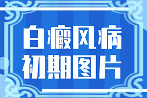 脸上白癞风就擦药膏不用吃药吗怎么治好