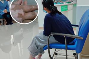 点阵激光进行治疗多少钱