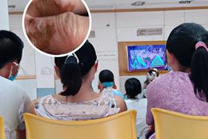 天天擦卤米松乳膏3个月还没好