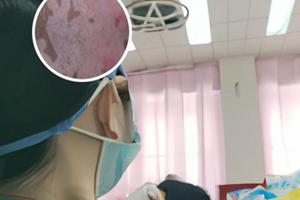 倍他米松乳膏可以长期使用吗