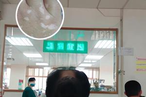 甲泼尼龙药店有吗