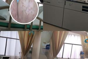 兰州中研医院看白斑怎么样