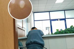谁在兰州中研白斑医院看过