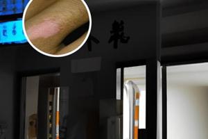 兰州中研白癜风怎么查病因