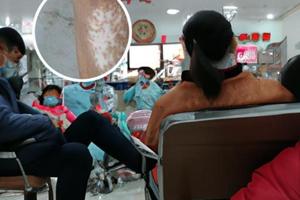 谁在兰州中研白殿风医院看过白殿风