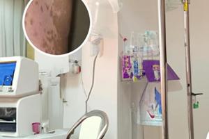 兰州中研治白斑医院怎么样