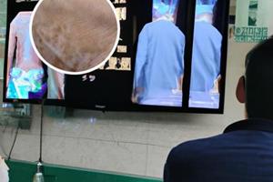 兰州中研白癫风医院治疗小儿白癫风案例