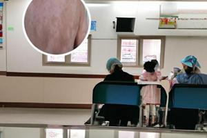 兰州白斑医院评价如何