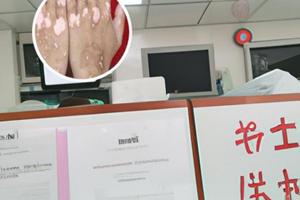 白点癫风是什么原因引起的怎样治疗最好最有效