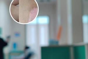 兰州中研医院治疗白癜风有用吗
