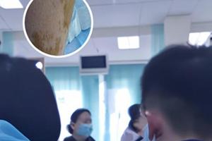 复方甘草片适用于什么症状