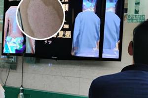 白癜风光疗效果不好