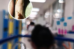 复方孜然酊白斑的治疗效果