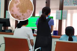 白癜风光疗后可以涂药膏吗