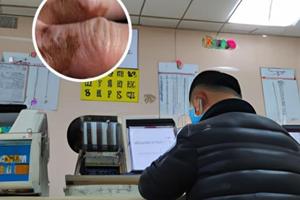糠酸莫米松乳膏可以治疗白斑吗