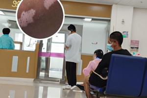 白癜风光疗后注意事项是什么