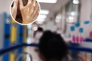 点阵激光费用多少钱
