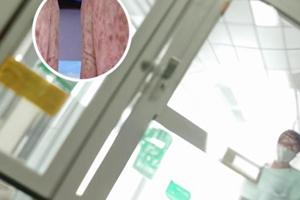 复方倍他米松效果多久