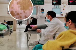 为什么擦上卤米松乳膏白斑没感觉了