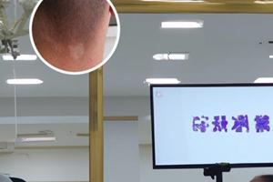 兰州中研白癜风专科医院怎么走