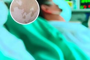 兰州中研白癜风医院收费价格