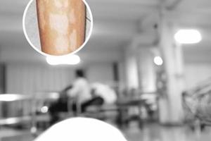 兰州中研白斑医院主要治什么病