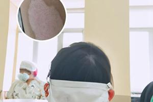 兰州中研看好多少有白癜风的人