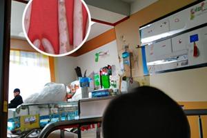 兰州中研医院有黑色素移植吗