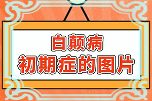 白疯癫怎么医治