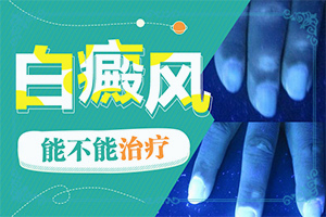 白点癫风擦什么药最好