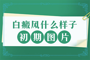 白癞风前期图片白癞风用药