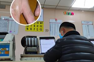谱特彼他克莫司软膏