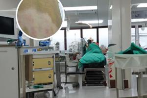 鲁索替尼乳膏效果好吗怎么样
