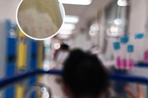 如他克莫司软膏功效