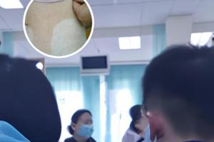 兰州白斑医院哪家