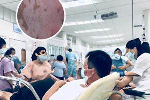 光疗治白癜风价格表一览表