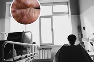 光疗治疗白癜风的危害是什么