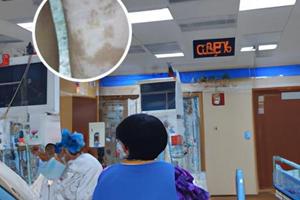 recell术后还需要做什么恢复