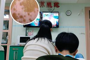 308和311光疗仪治白斑哪个好
