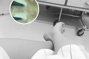 点阵激光恢复期图片