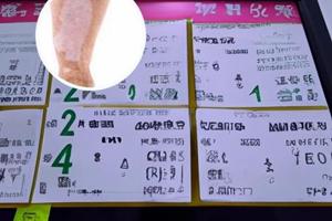色素脱失症有没有什么药可以治