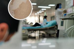 光疗治白斑效果如何