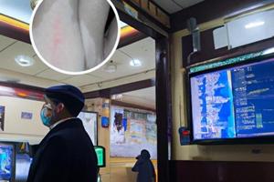 丙酸倍他米松乳膏有什么副作用