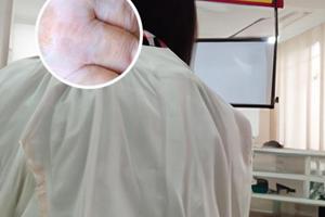 兰州中研医院治疗白癜风有用吗