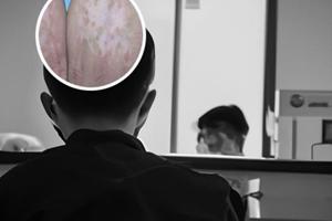 兰州中研医院黑色素移植费用