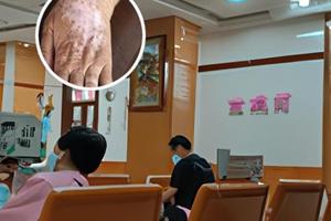 兰州中研白癜风治疗病例